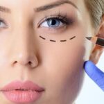 ¿Cuánto cuesta una blefaroplastia y qué debes saber antes de someterte a esta cirugía estética en Valencia?