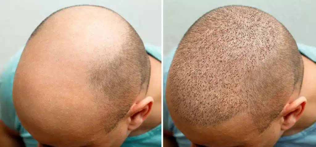 Tratamientos estéticos Implante de cabello