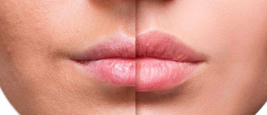 Tratamientos estéticos aumento de labios